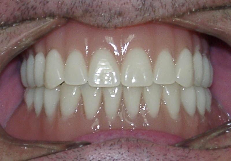 Prótesis dental en Fuenlabrada