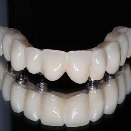 Implantes dentales Villaviciosa de Odón