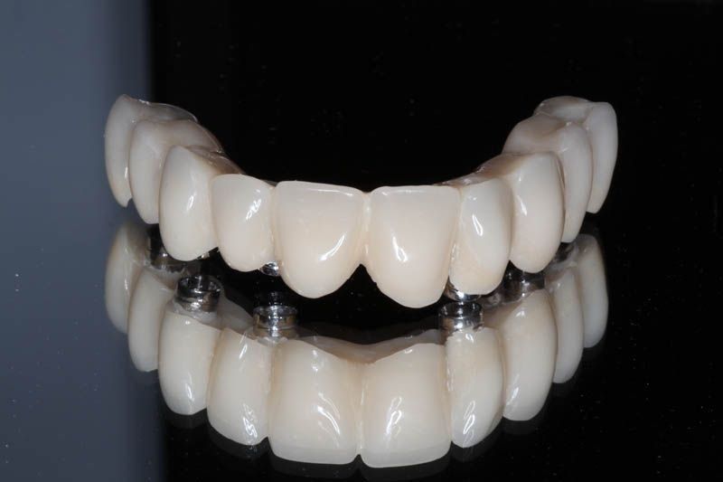 Implantes dentales Villaviciosa de Odón