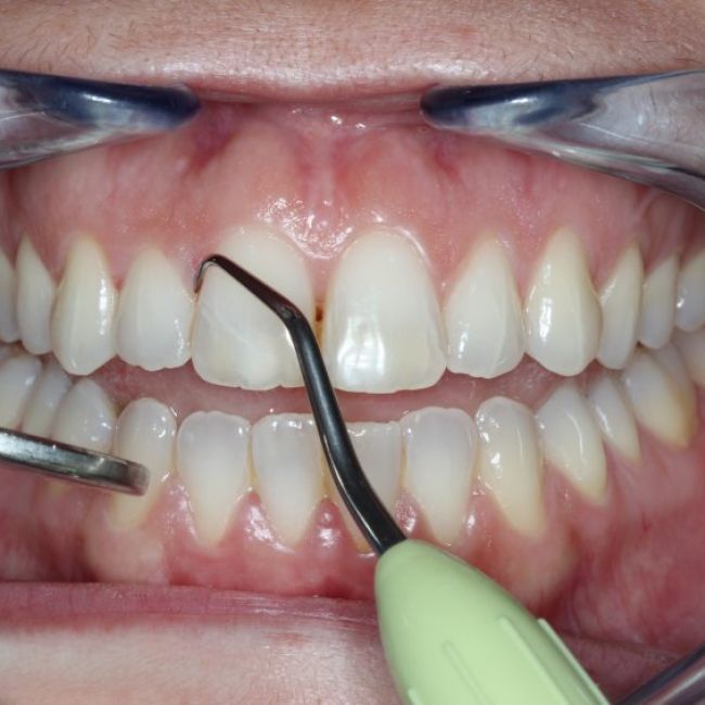 Enfermedad periodontal