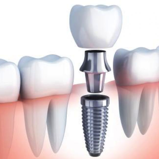 Falsos mitos sobre los implantes dentales