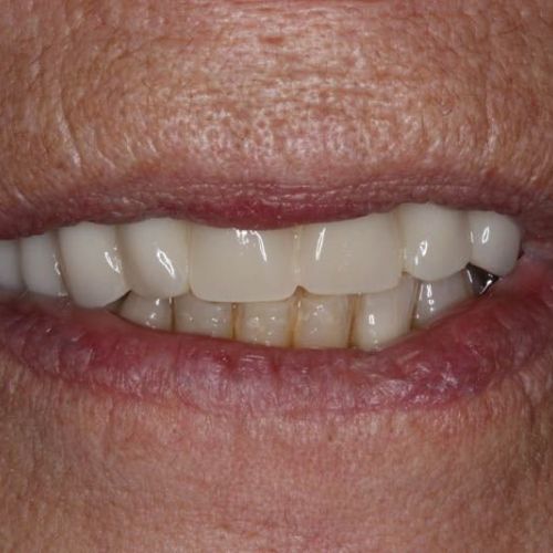 Implantes dentales en Fuenlabrada