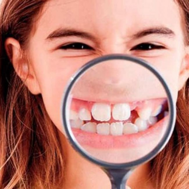 Ventajas de corregir la malposición dental