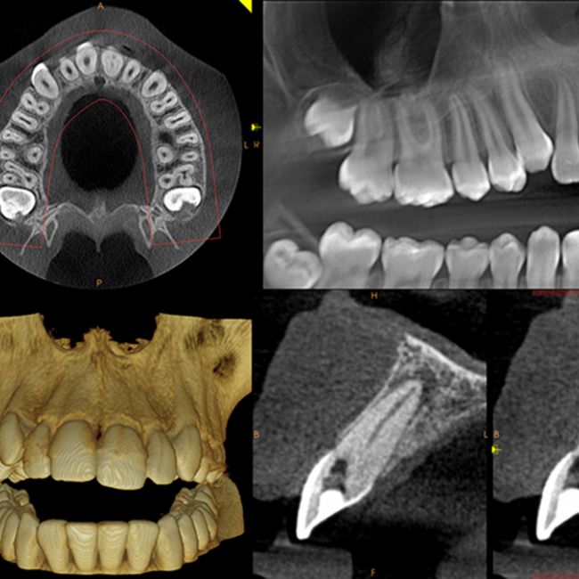 CBCT dental