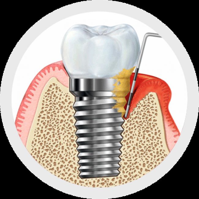 Periimplantitis: síntomas, causas y tratamiento