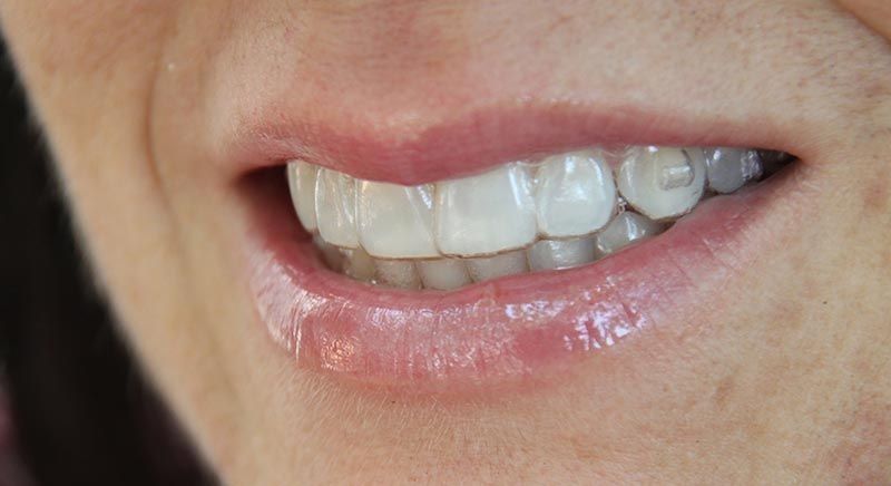 La importancia de utilizar retenedores dentales