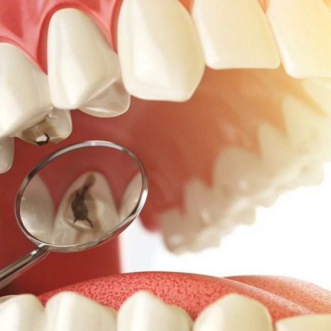 Odontología conservadora en Villaviciosa de Odón