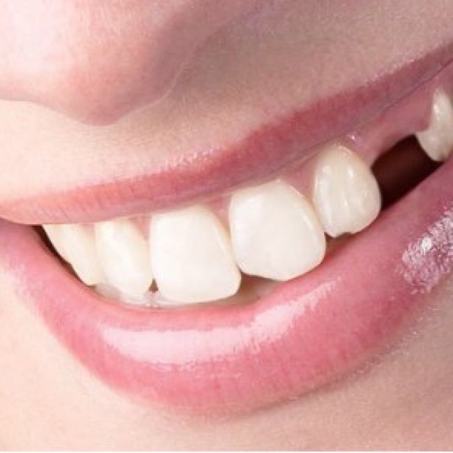 Reconstrucción dental en Fuenlabrada