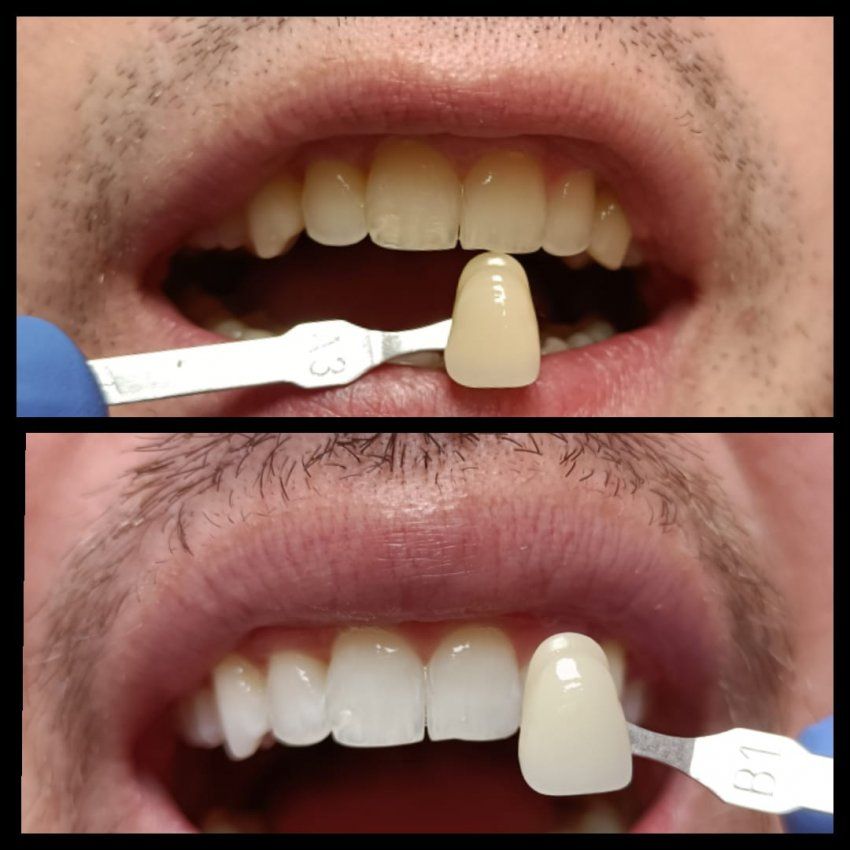 Blanqueamiento dental en Villaviciosa de Odón Blanqueamiento dental en Villaviciosa de Odón