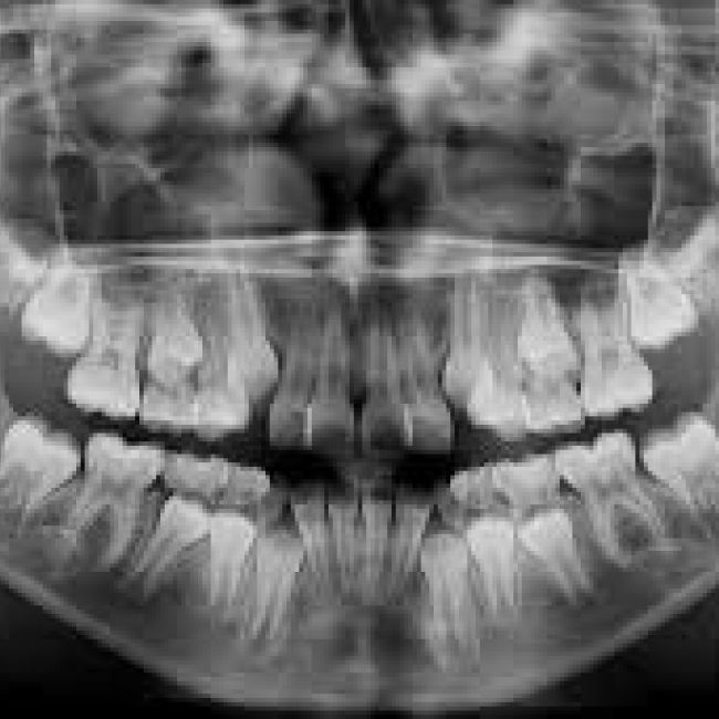 Radiografías dentales ¿son peligrosas? ¿para qué sirven?