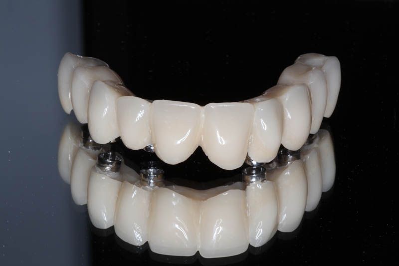 Fuenlabrada implantes dentales