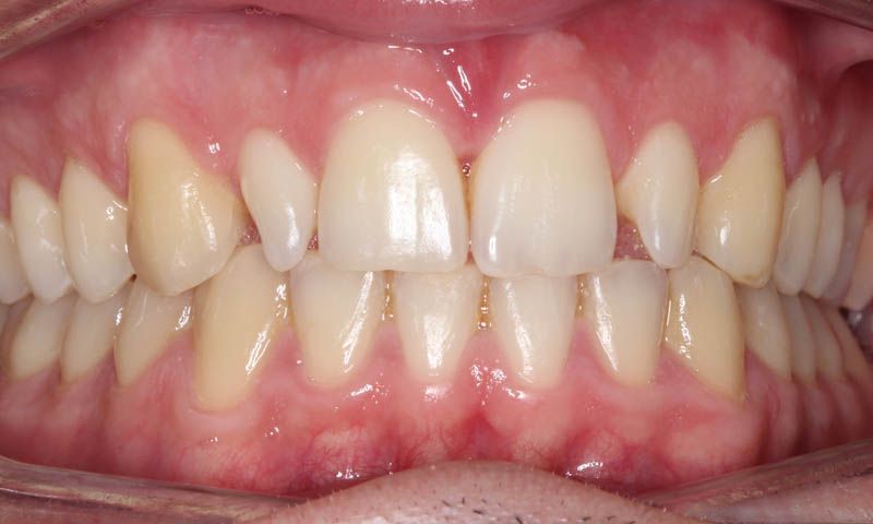 carillas composite en dientes laterales