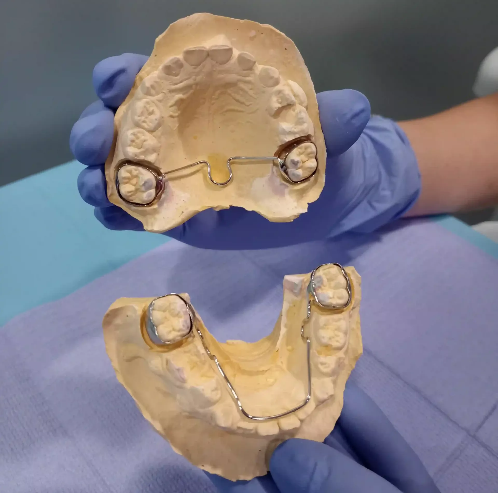 Barra transpalatina y arco lingual puestos en un molde dental