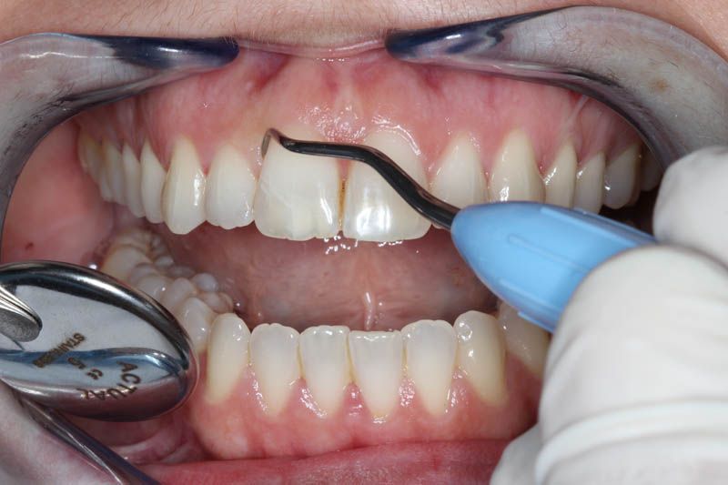 tratamiento periodontal en Fuenlabrada