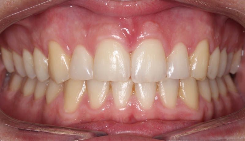 carillas composite en dientes laterales