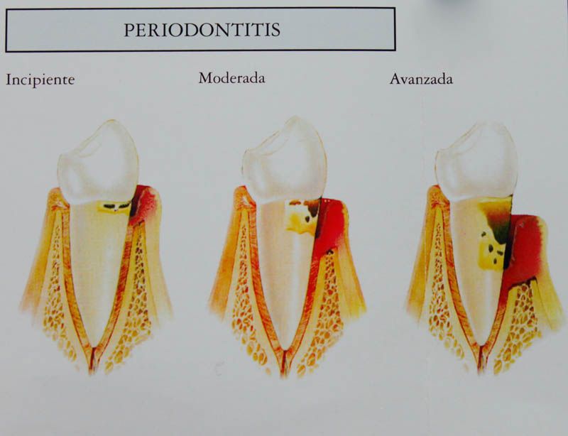 periodonitis Fuenlabrada
