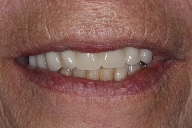 Fuenlabrada implante dental