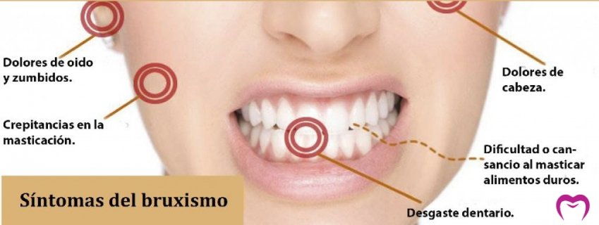 ¿Rechinas los dientes? Puede que tengas bruxismo