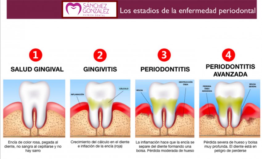 Enfermedad periodontal