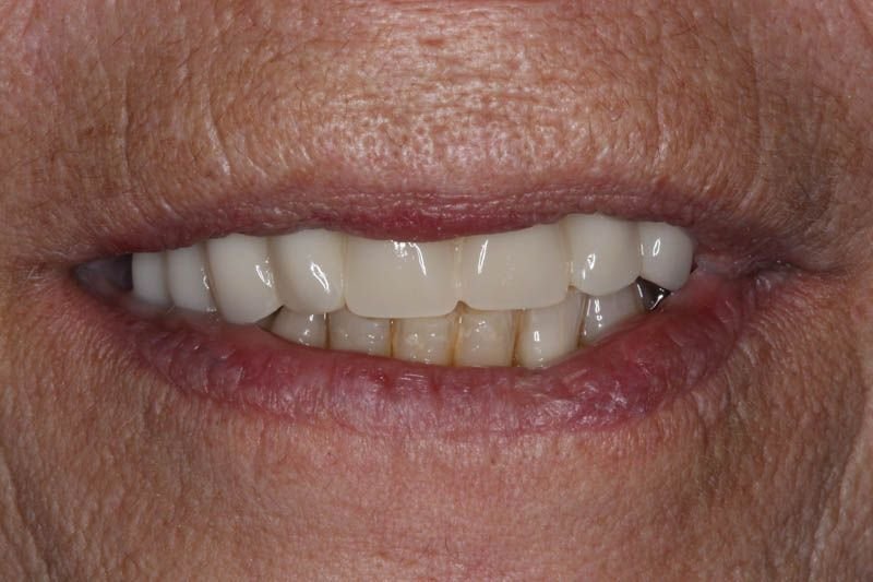implantes_dentales_fuenlabrada.jpeg