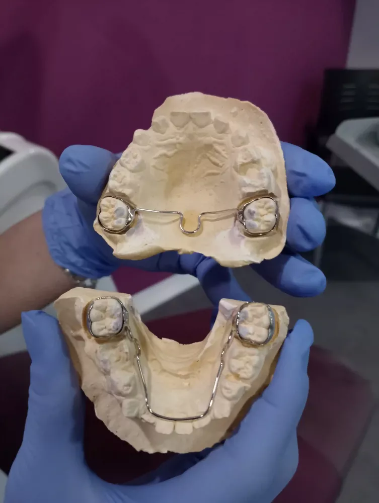 Barra transpalatina y arco lingual puestos en un molde dental