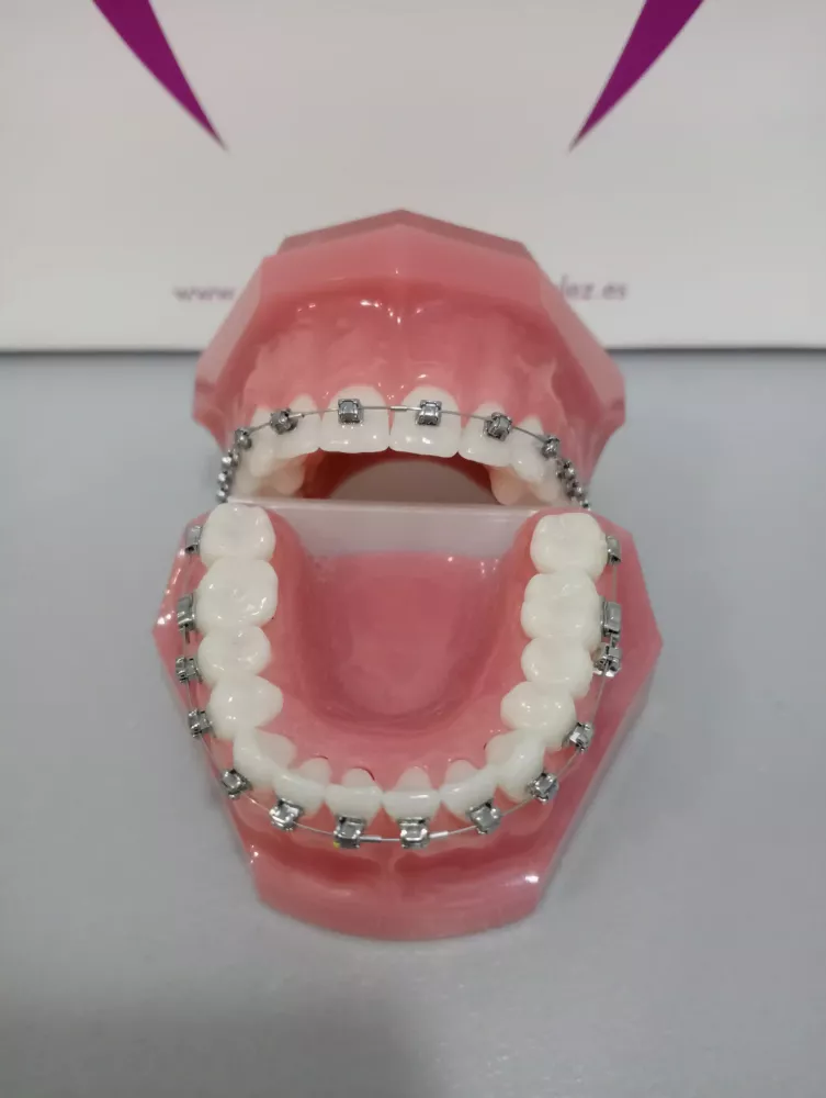 Brackets puestos en un una dentadura falsa